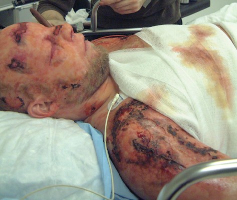 Bomb explosion victim with edema prosthetics and burns